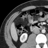Correlative, axial CECT illustrates the muscles of the abdominal wall. The rectus abdominis muscle in the anterior abdominal wall, and the oblique and transversus abdominis muscles in the anterolateral abdominal wall and their aponeuroses are shown.