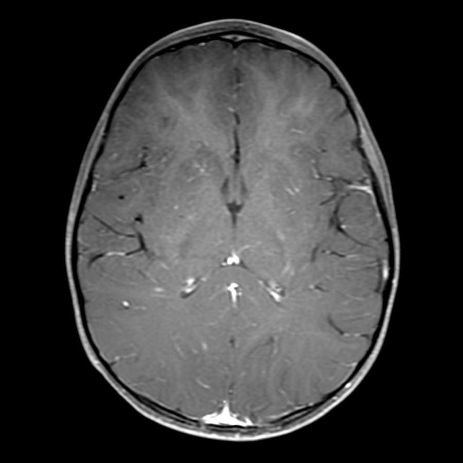 Axial T1 C+ FS MR in the same patient reveals minimal, if any, enhancement within the same abnormal brain regions.