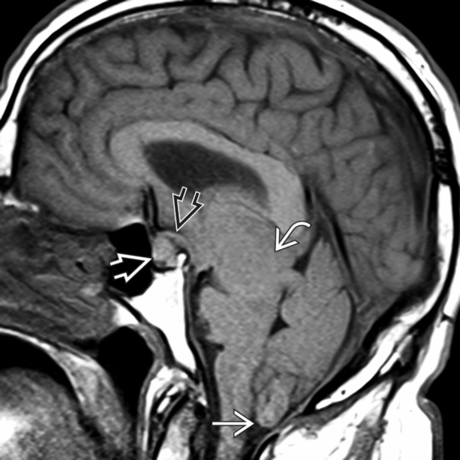 Sagittal T1WI MR in the same patient shows changes of severe IH with midbrain slumping  , downward tonsillar displacement , "fat" pituitary gland , and "draping" of the optic chiasm/hypothalamus over the dorsum sellae .