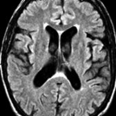 Axial FLAIR shows mild periventricular hyperintensity   & mild enlargement of the ventricles & sulci in a 65-year-old man. No focal hyperintensities are seen in the hemispheric white matter; cortical thickness & signal intensity are normal.