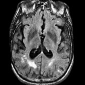 Axial FLAIR MR demonstrates only mild white matter hyperintensity, as well as a very small cortical/subcortical infarct  in a patient with vascular dementia.