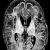 Axial FLAIR MR in a newborn shows large,  fairly symmetric cystic areas of encephalomalacia  in both cerebral hemispheres with associated volume loss. Cystic encephalomalacia was a result of hypoxic-ischemic encephalopathy at birth.