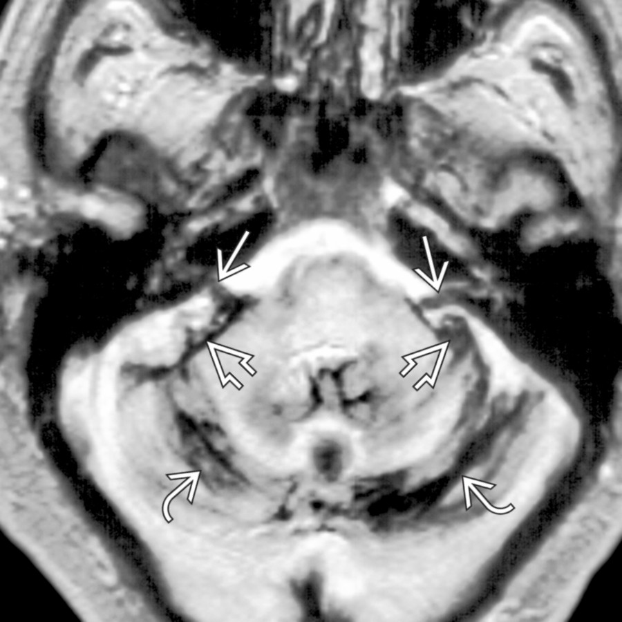 Axial T2* GRE MR shows superficial siderosis on the surface of the posterior fossa structures (linear low signal), including cerebellar folia , flocculi , and vestibulocochlear nerves .