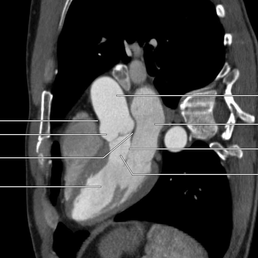 Three-chamber view from a CT angiogram depicts the anatomy of the left ventricular outflow tract and aortic root.
