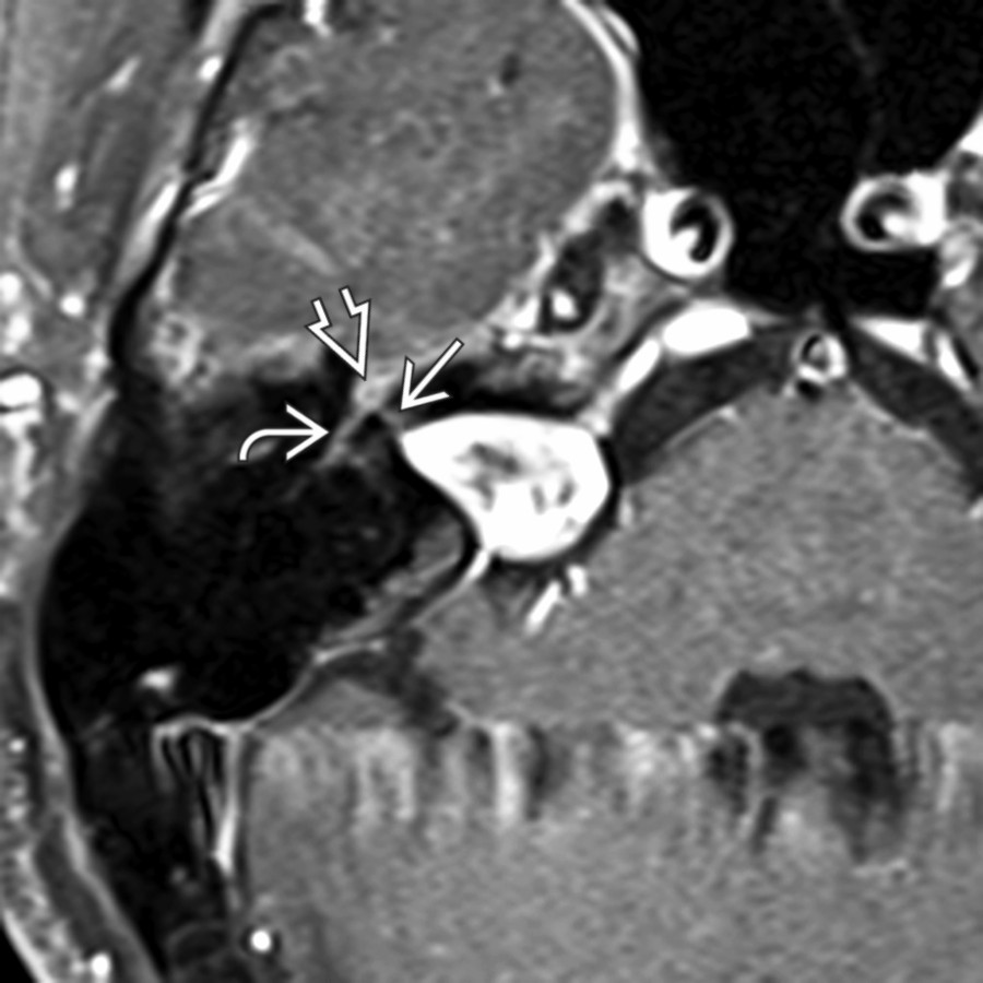 Axial T1 C+ FS MR in a patient with right vestibular schwannoma demonstrates increased enhancement of the labyrinthine  CNVII, geniculate ganglion , and anterior tympanic segment  CNVII.