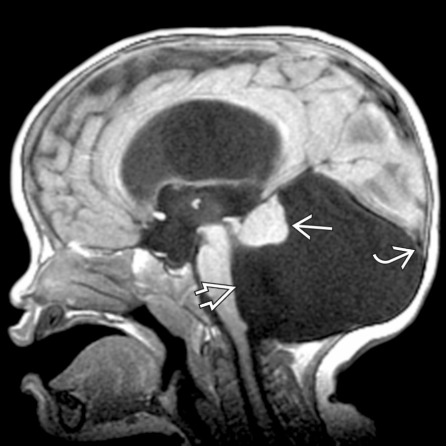 Sagittal T1WI MR demonstrates a markedly enlarged posterior fossa with cystic dilatation of the 4th ventricle , upwardly rotated hypoplastic vermis , and low-lying torcular Herophili .