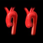 Graphic compares a normal ascending aorta (left) with a well-defined sinotubular junction  and annuloaortic ectasia with sinotubular junction effacement (right).