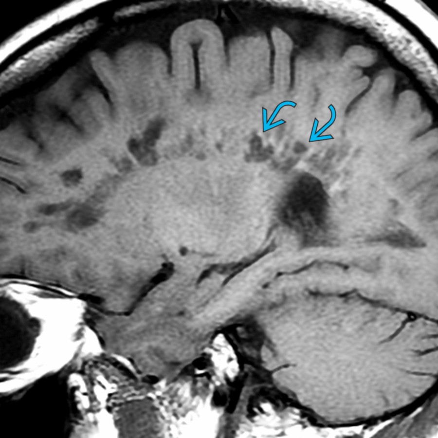Sagittal T1 MR in a patient with longstanding MS shows ovoid lesions in the periventricular WM with ill-defined hyperintense rims  surrounding the plaques, giving the distinct lesion within a lesion appearance.