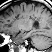 Sagittal T1 MR in a patient with longstanding MS shows ovoid lesions in the periventricular WM with ill-defined hyperintense rims  surrounding the plaques, giving the distinct lesion within a lesion appearance.