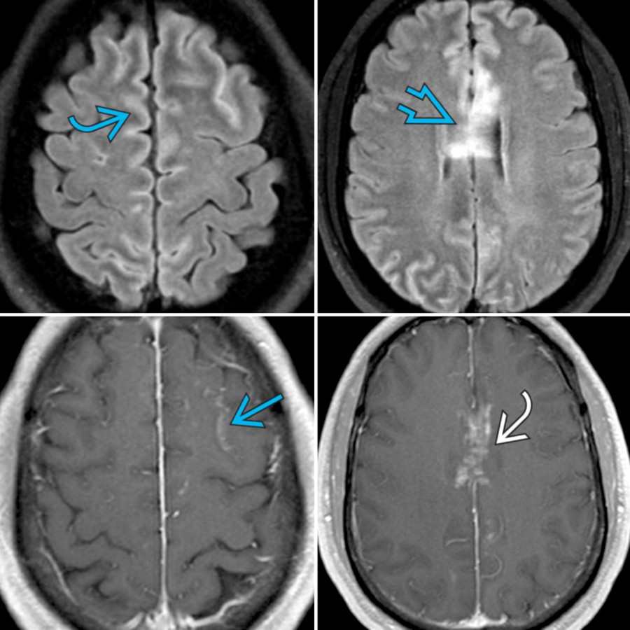 Axial FLAIR (top) and T1 C+ MR (bottom) show patchy hyperintensity involving the cortex , cingulate gyrus, and corpus callosum  with leptomeningeal  and nodular  enhancement. MOG was (+) and AQP4-IgG was (-).