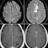 Axial FLAIR (top) and T1 C+ MR (bottom) show patchy hyperintensity involving the cortex , cingulate gyrus, and corpus callosum  with leptomeningeal  and nodular  enhancement. MOG was (+) and AQP4-IgG was (-).