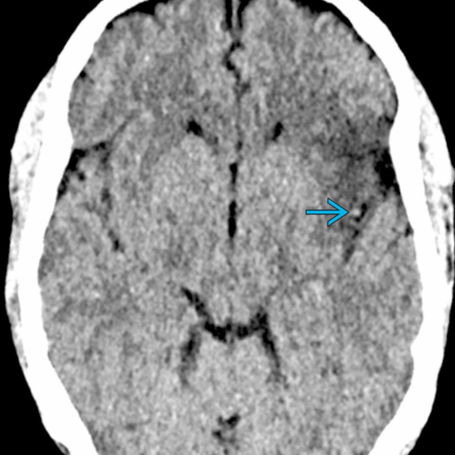 Axial NECT shows ↑ density related to a dot sign in a distal left MCA branch ,  representing acute thrombus. Hypodensity related to early infarct is seen in the adjacent brain parenchyma.