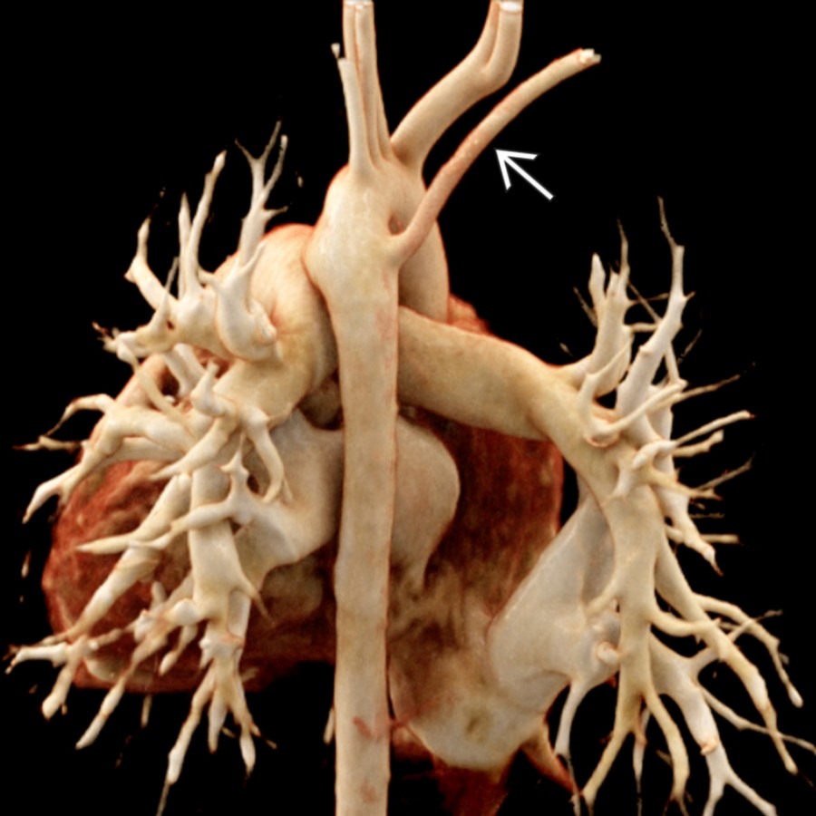 CTA cinematic rendering reconstruction shows ARSA  that originates as the last branch from the aortic arch and courses behind the esophagus to reach the right.