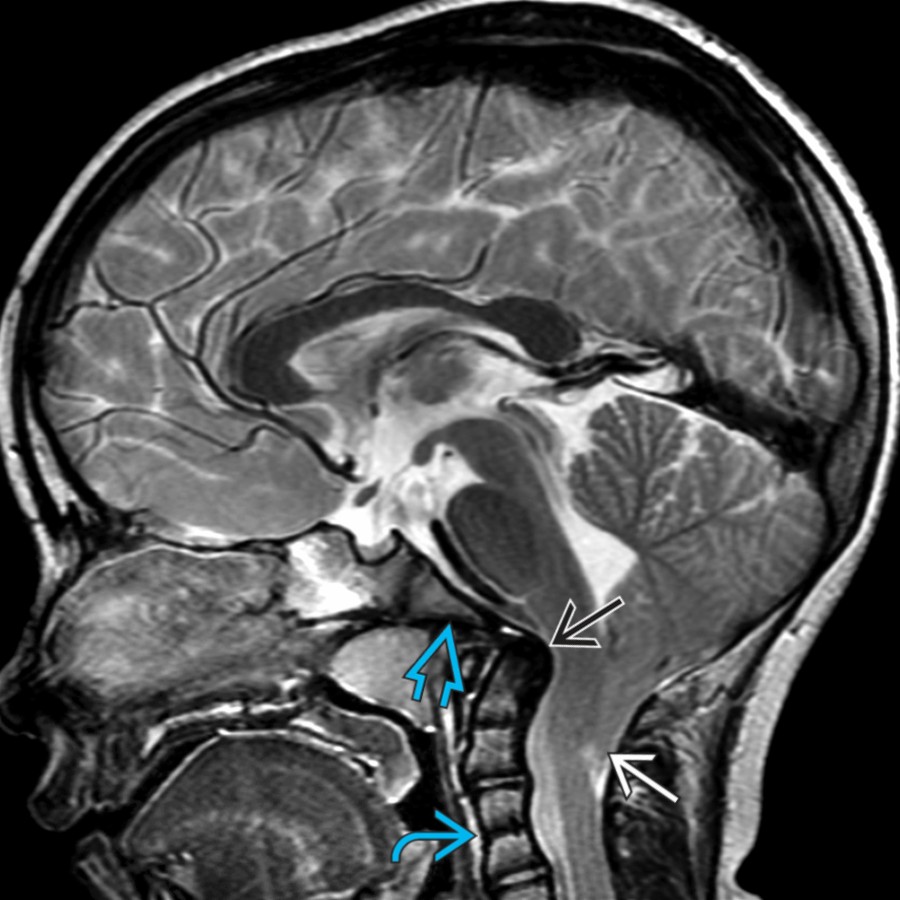 Sagittal T2 MR in a 5 year old with occipital headaches demonstrates pointed, low-lying cerebellar tonsils  with associated effacement of CSF spaces. Note the short horizontal clivus , retroverted dens , and segmentation anomaly at the C3-4 levels .