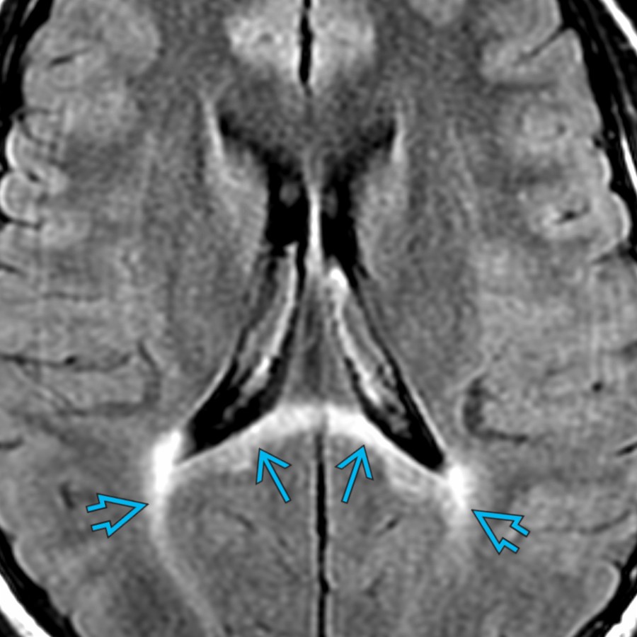 Axial FLAIR MR in a 14-year-old male patient with X-linked adrenoleukodystrophy (ALD) shows symmetric increased FLAIR signal intensity  that crosses the splenium  of the CC. This is the most common distribution of signal abnormality in X-linked ALD.