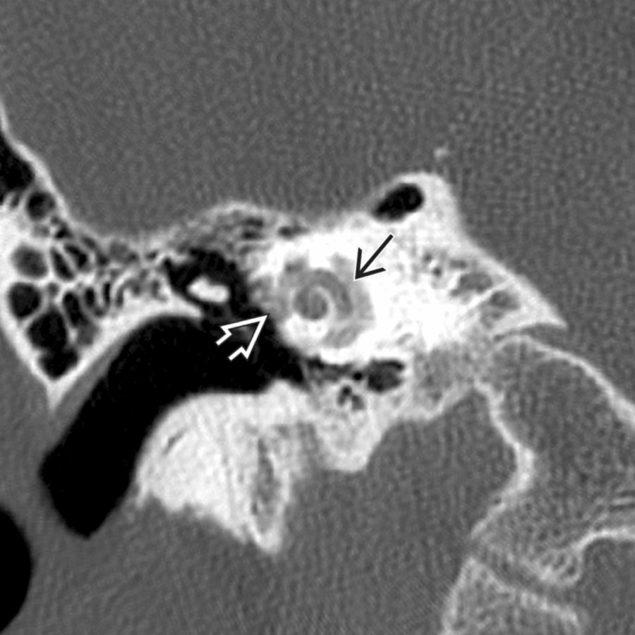 Coronal right temporal bone CT in a patient with mixed hearing loss shows a "halo" of radiolucency surrounding the cochlea ,  representing cochlear otosclerosis. Also note the associated fenestral otosclerosis .