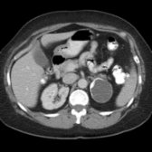 Axial CECT in a 51-year-old woman shows an incidental, peripherally calcified left adrenal cyst . Coarse calcification suggests a pseudocyst. Pseudocysts may be due to prior trauma/hemorrhage, but this history is often absent.