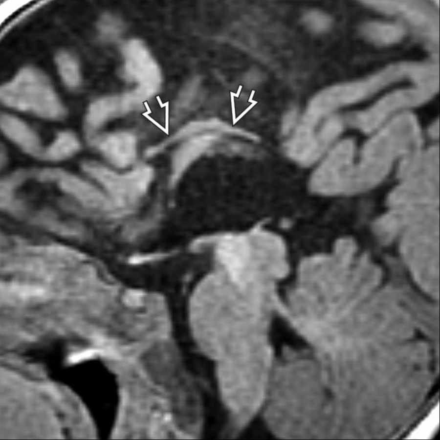 Midline sagittal T1 MR in a 5 month old with isolated callosal dysgenesis shows a very short & thin CC  with no evident rostrum or splenium. Isolated callosal dysgenesis is uncommon. Associated anomalies should be carefully sought.