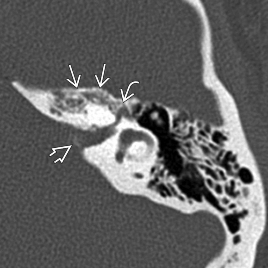 Axial bone CT shows an FNVM within the anteromedial temporal bone  and in the bone surrounding the geniculate fossa . Subtle foci of increased density  are also seen in the IAC.