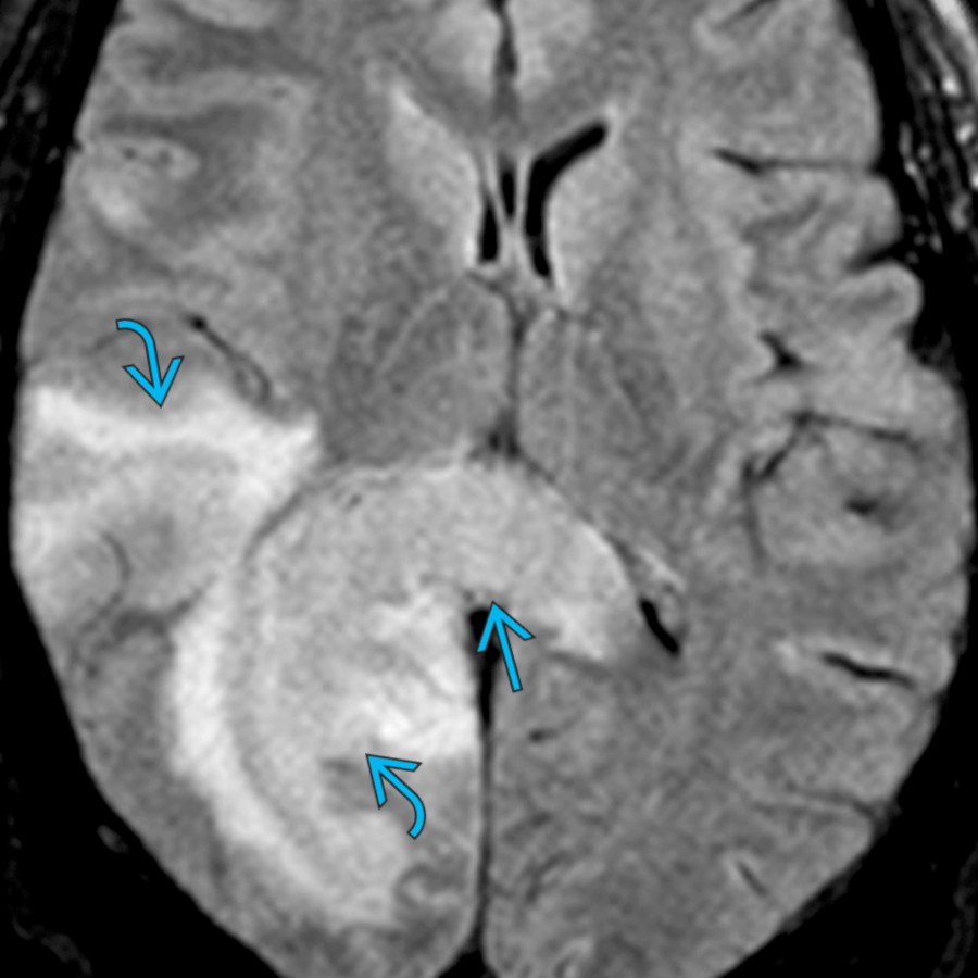 Axial FLAIR MR in a patient with AQP4-IgG (+) NMOSD demonstrates large confluent lesions in the right temporal and occipital regions  with involvement of the splenium   of the corpus callosum.