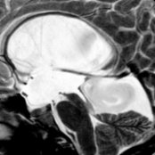 Sagittal T2WI MR shows massively enlarged 3rd  and lateral ventricles and an enlarged, funnel-shaped aqueduct  related to aqueductal stenosis in this child. There is also a medial atrial diverticulum  compressing the 4th ventricle .