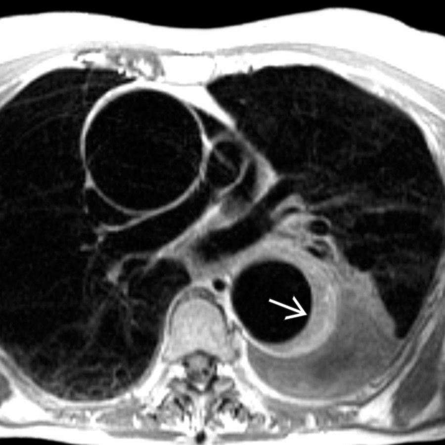 Axial black-blood MR in a patient with type B IMH shows the presence of hyperintense crescentic IMH  along the descending thoracic aorta. This intensity behavior is consistent with acute hemorrhage.