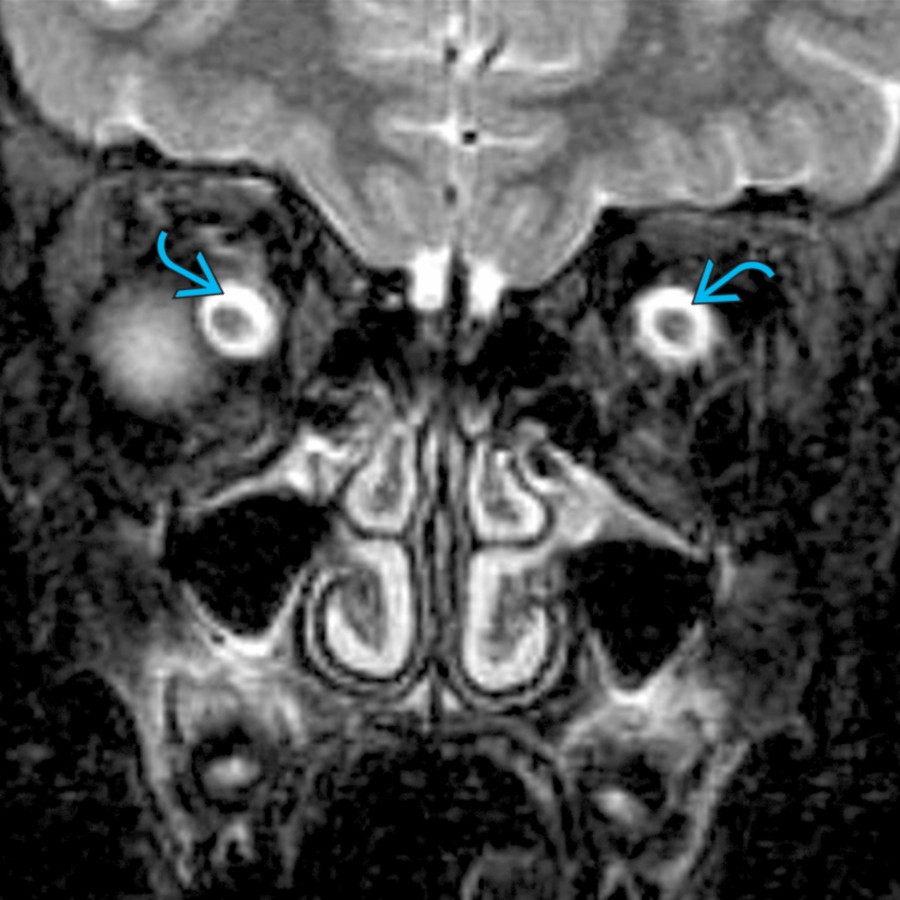 Coronal T2 FS MR of orbits in a 6 year old with papilledema and opening CSF pressure of 32 cm of H₂O shows dilated optic nerve sheaths bilaterally .