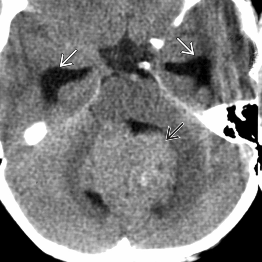 Axial NECT in the same patient shows the large intraventricular mass  within the 4th ventricle. Note the dilated temporal horns .