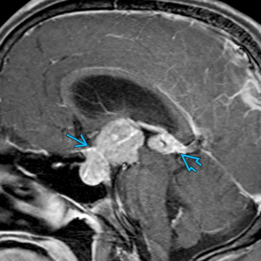 Sagittal T1 C+ FS MR shows enhancing masses in the suprasellar  and pineal  regions in a young male patient. Imaging mimics a germinoma. Biopsy revealed an embryonal carcinoma. Elevation of serum markers β-hCG and AFP is characteristic.
