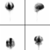 In the same patient, 24-hour multiplanar images show flow of tracer over convexities and into interhemispheric fissure . There is no definite ventricular activity.