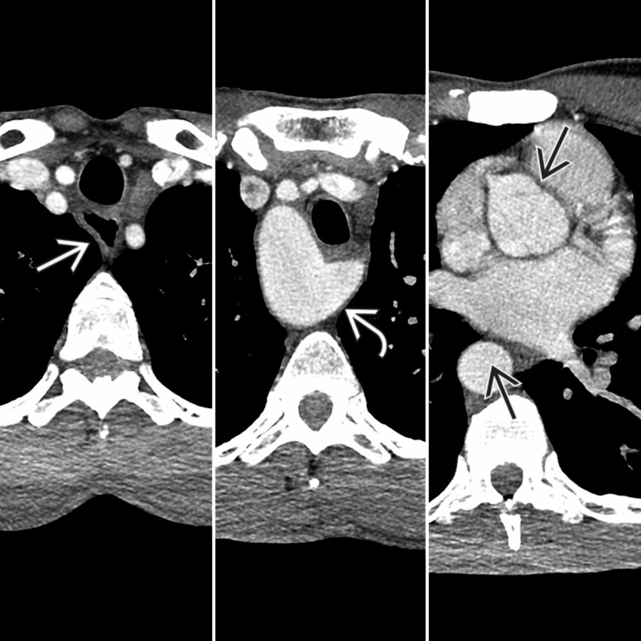 Composite axial chest CTA in a patient with RAA, ALSA, and KD demonstrates RAA  and ALSA/KD  with mild dilatation of the proximal esophagus  superior to the KD.