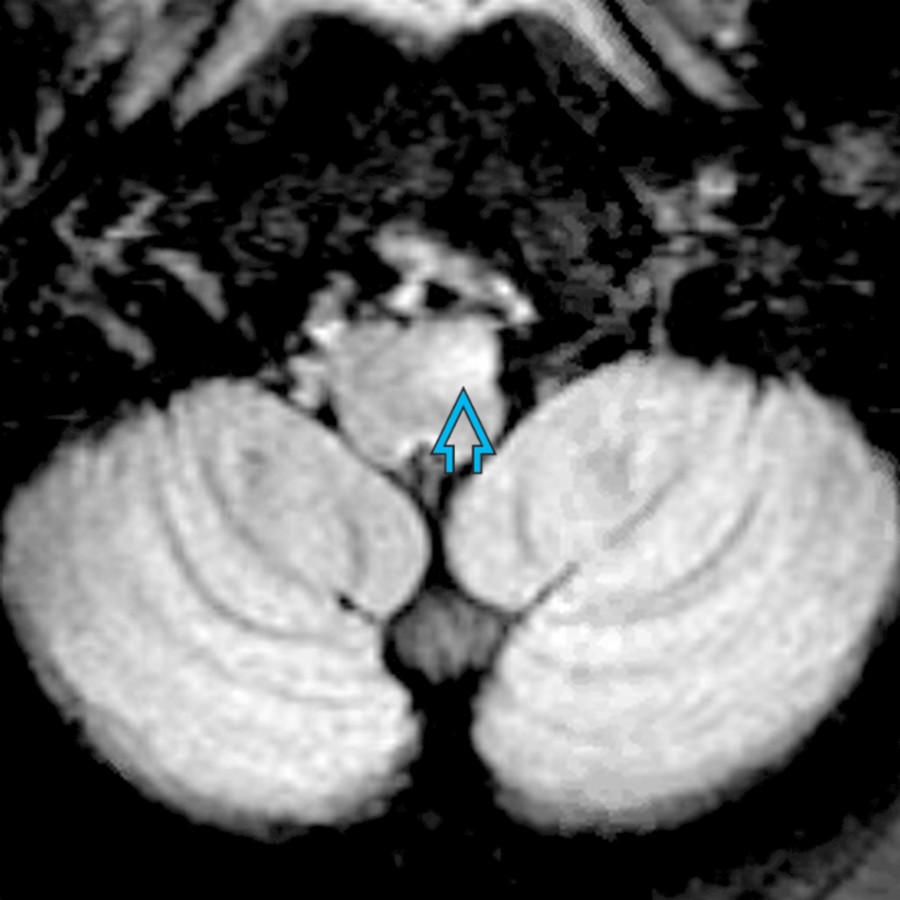 Axial FLAIR MR in the same patient shows enlarged left inferior olivary nucleus with hyperintense signal  due to HOD.