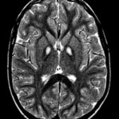Axial T2WI MR in a 5 year old with cerebral palsy demonstrates eye of the tiger sign typical of pantothenate kinase-associated neurodegeneration (PKAN): Symmetric areas of high T2 signal  within the medial globus pallidus with surrounding pallidal hypointensity.