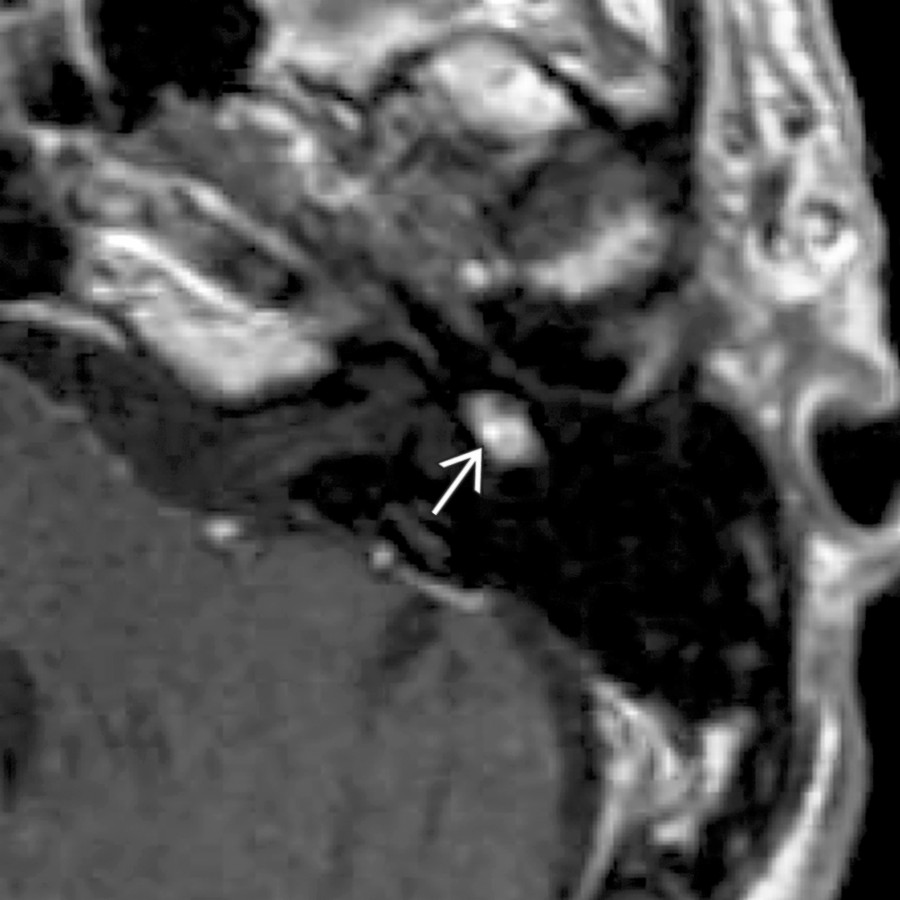 Axial T1 C+ MR in the same patient shows enhancing schwannoma    corresponding to the area of smooth osseous expansion on CT.