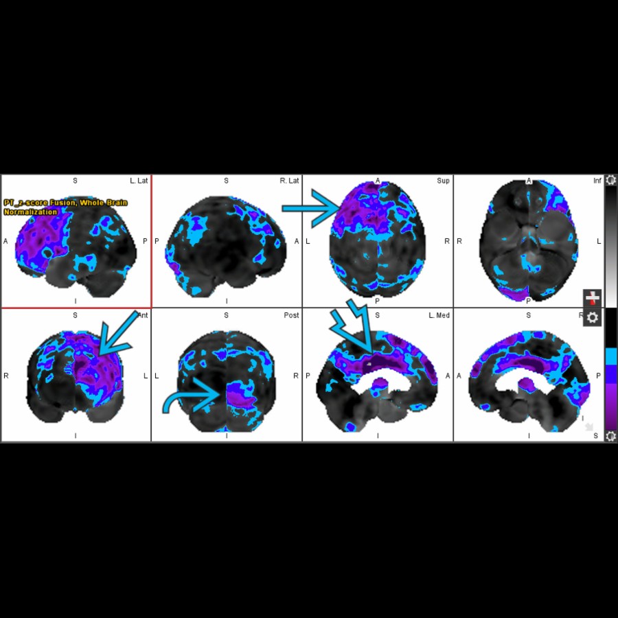 Surface mapping of an FDG PET scan performed in a 96-year-old man demonstrates multiple areas of significant cortical abnormality in glucose metabolism, including the left frontal lobe , the right occipital lobe  and the cingulate gyrus , consistent with multiinfarct dementia.