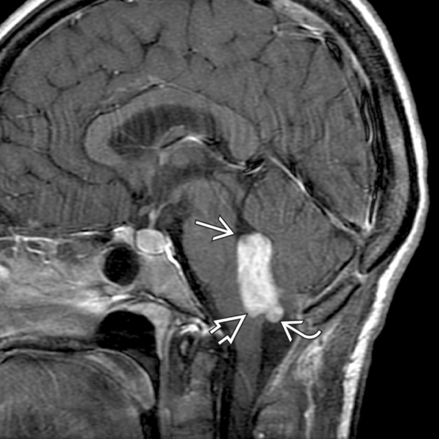 Sagittal T1 C+ MR shows an enhancing mass expanding the 4th ventricle . The mass is also distending the obex   and protruding through the foramen of Magendie into the cisterna magna .