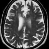 Axial T2WI MR shows atrophy & white matter changes of aging .
