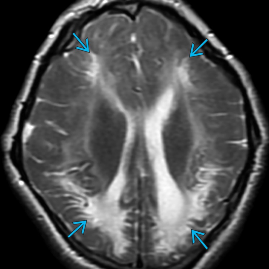 Axial T2 MR in a 9 year old with a history of hypoxic-ischemic encephalopathy (HIE) at birth shows extensive gliosis & encephalomalacia causing WM volume & signal abnormality in a watershed distribution . This results in marked CC thinning.