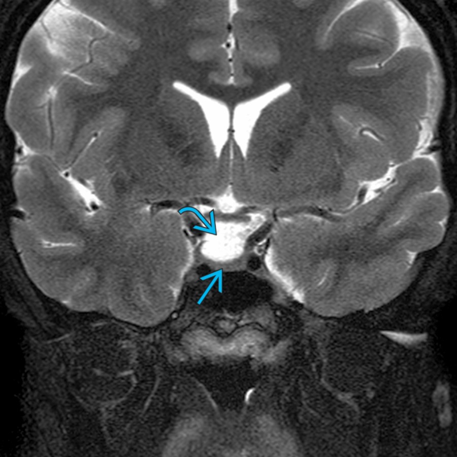 Coronal T2 FS MR in the same patient shows a partially empty sella  with the pituitary gland  flattened along the floor of the sella. Idiopathic intracranial hypertension is more commonly observed in overweight women of reproductive age. Treatment includes weight loss and medications, as well as lumbar punctures, shunt, and optic nerve fenestration.
