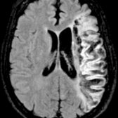 Axial FLAIR MR in a patient with VaD shows large remote infarction in the left middle cerebral artery distribution . Note associated prominent cortical sulci  and ex vacuo dilation of left lateral ventricle  due to parenchymal atrophy.