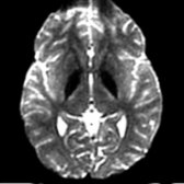 Axial DWI with zero B value MR shows symmetric hypointensity within the GP with subtle "blooming" secondary to susceptibility artifact from iron. These findings are characteristic of NBIA, an umbrella term that includes former Hallervorden-Spatz syndrome without "eye of the tiger."