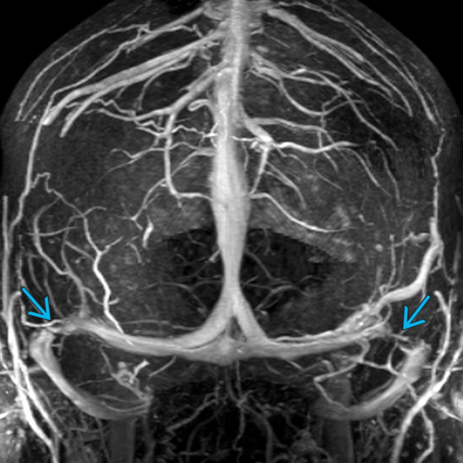 MIP image of a postcontrast MR venogram study in a patient with IIH shows stenosis of the distal transverse sinuses bilaterally , right > left.