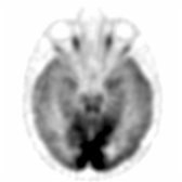 Axial F-18 FDG PET in a patient with advanced amnestic AD shows decreased activity throughout the cortex with sparing of the occipital lobe , which distinguishes it from LBD.