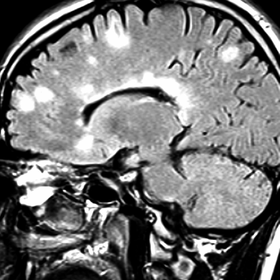 Sagittal FLAIR MR shows numerous MS plaques with typical perpendicular orientation at the callososeptal interface along penetrating venules ("Dawson fingers") as well as in the subcortical white matter.