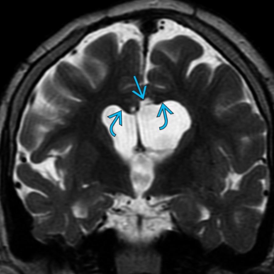 Coronal T2 MR shows absence of the midline CC  with persistent paramidline callosal tissue , consistent with an isolated surgical callosotomy.
