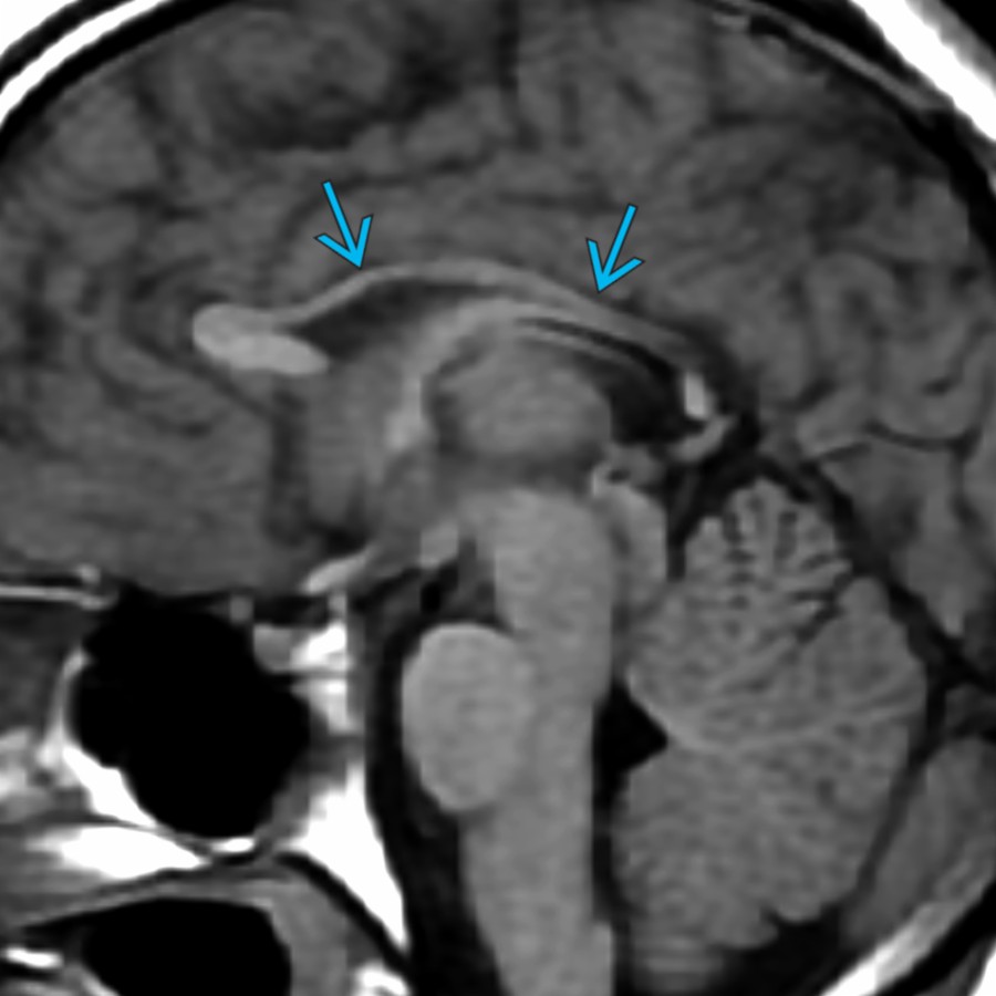 Midline sagittal T1 MR in the same patient shows marked thinning of the CC  secondary to WM loss as a consequence of the remote HIE injury.
