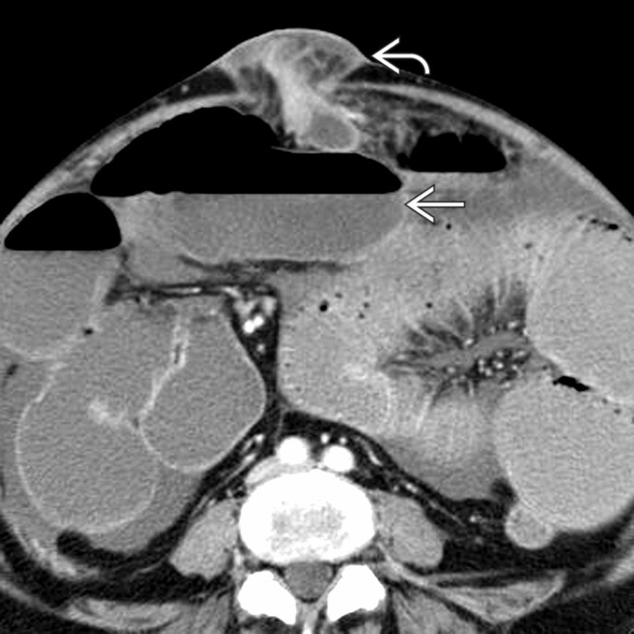 Axial CECT demonstrates an umbilical hernia  containing a short segment of bowel. Dilated bowel  leads into the hernia, suggesting bowel obstruction caused by a strangulated umbilical hernia.