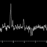 MRS at long TE in a patient with acute lesions in ADEM demonstrates ↑ choline , ↓ NAA , and the presence of a lactate doublet . Increase in choline with corresponding reductions in NAA normalize as the clinical and conventional neuroimaging abnormalities resolve.