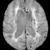 Axial SWI MR in a 73-year-old woman with VaD demonstrates multiple scattered remote microhemorrhagic foci  predominantly in peripheral distribution.