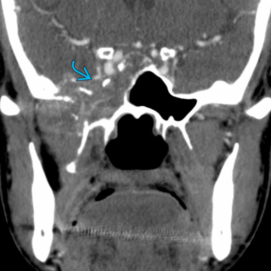 Coronal CECT in a patient with metastatic breast carcinoma shows a large sellar/parasellar mass  with extension to the cavernous sinus and destruction of the adjacent central skull base.